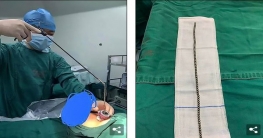 ১১ বছরের শিশুর লিঙ্গের ভেতর ৭০টি চৌম্বক গুটি!