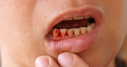 মাড়ি থেকে রক্ত পড়লে করণীয়