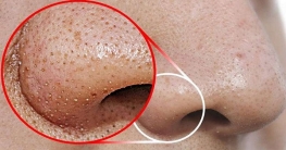 নাকে-মুখে ব্ল্যাকহেডস দূর করবে আলু