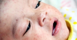 ফিলিপাইনে হামের প্রাদুর্ভাব, ৫০ জনের মৃত্যু