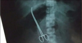 পেটের ভেতর কাঁচি রেখেই সেলাই দিলেন চিকিৎসক!