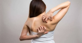 গরমে ঘামাচি নিরাময়ে ঘরোয়া উপায়